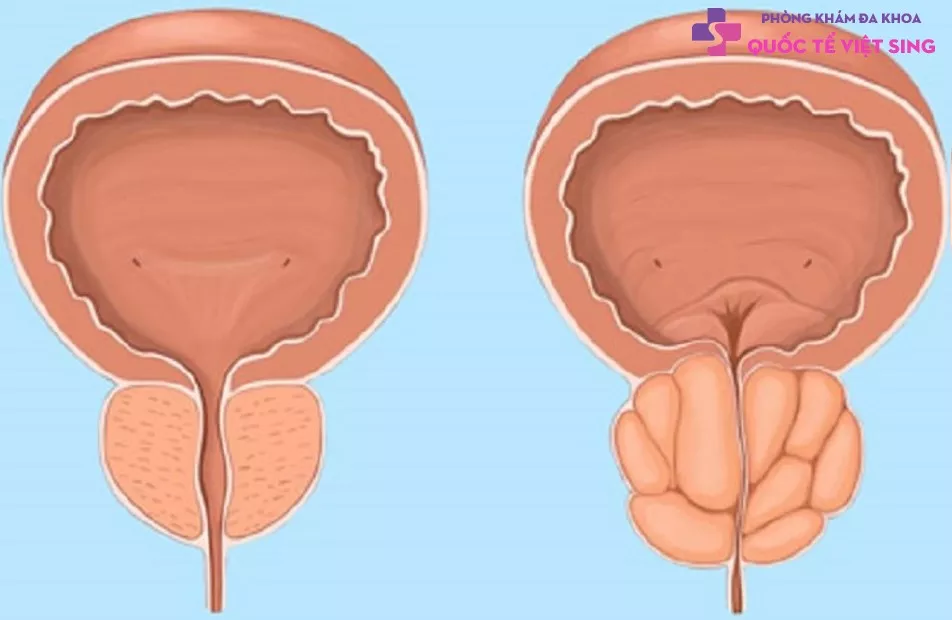 Bệnh tiền liệt tuyến là gì?