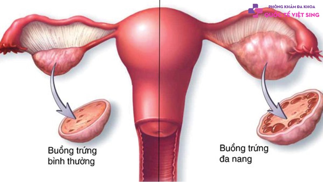 Bệnh buồng trứng là gì?