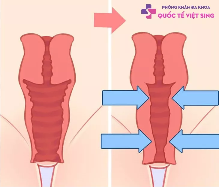 Thu nhỏ âm đạo là gì?