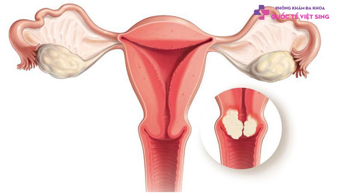 U xơ cổ tử cung là gì?