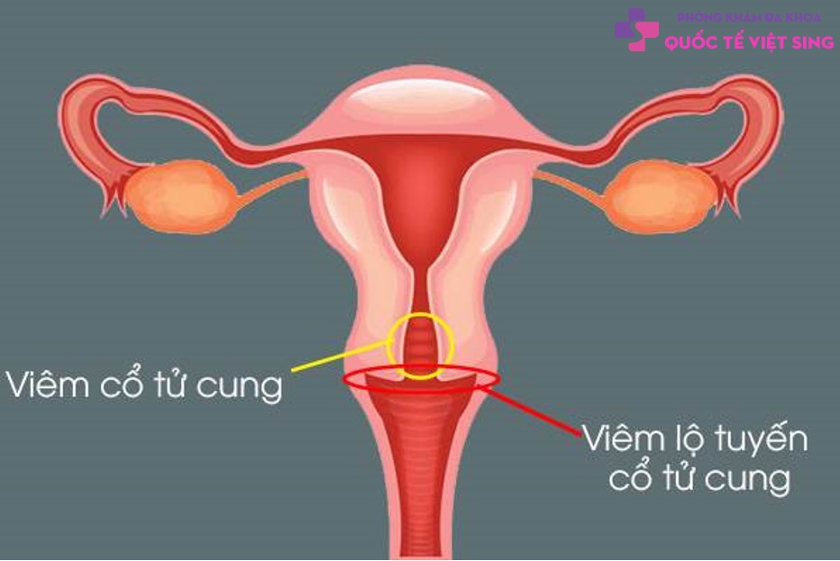 Viêm lộ tuyến cổ tử cung là gì?