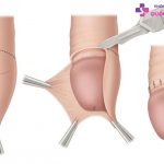 Cách lột bao quy đầu tại nhà siêu dễ thực hiện mà an toàn, hiệu quả