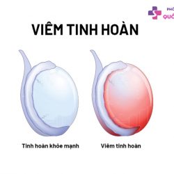 https://dakhoaquoctebacninh.vn/wp-content/uploads/2023/10/viem-tinh-hoan-bao-lau-thi-khoi-1-250x250.jpg