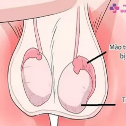 https://dakhoaquoctebacninh.vn/wp-content/uploads/2023/11/viem-mao-tinh-hoan-trai-1.jpg-250x250.webp