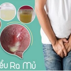 Tiểu buốt có mủ ở nam giới có nguy hiểm không và chữa bằng cách nào ?