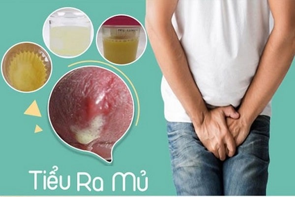 Tình trạng tiểu buốt có mủ ở nam giới do đâu mà có ?