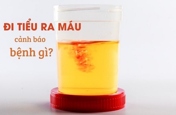 Giải đáp: Đi tiểu ra máu là bệnh gì?