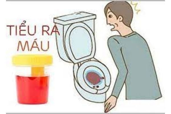 Đi tiểu ra máu là gì ?