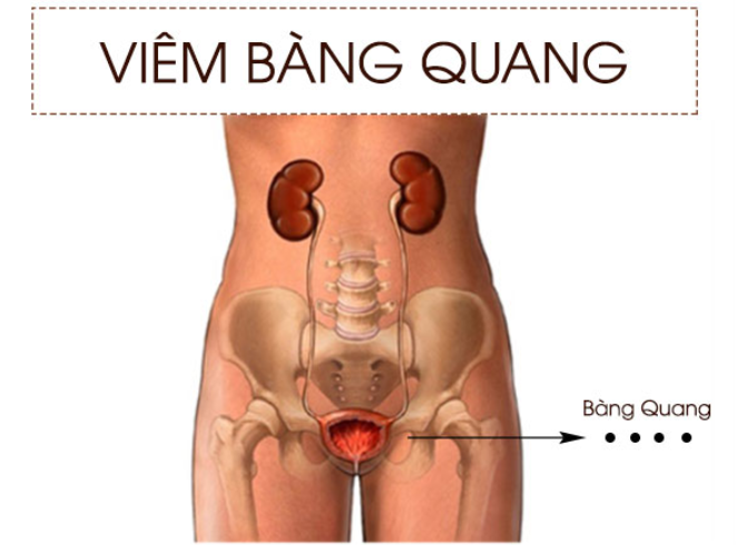 Tiểu buốt đau bụng dưới cảnh bảo bệnh gì - Viêm bàng quang