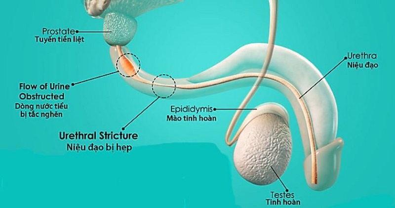 Tiểu buốt đau bụng dưới cảnh bảo bệnh gì - Hẹp niệu đạo