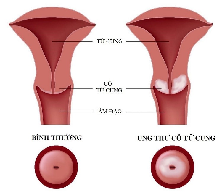 Tiểu buốt đau bụng dưới cảnh bảo bệnh gì - Ung thư cổ tử cung